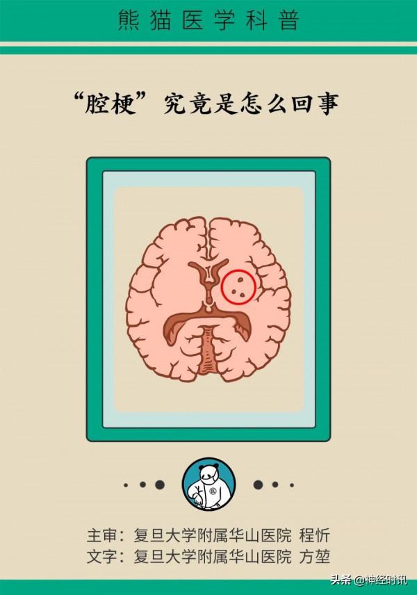 “腔隙性腦梗”到底怎麼回事？這篇文章全說透了