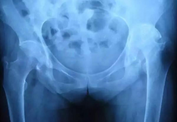 強直性脊柱炎可以丟掉手裡的藥了！半小時PRP軟骨修復治療病情