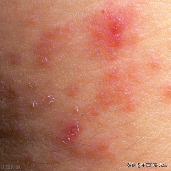 銀屑病（牛皮癬）的病因分析及中醫如何辨證論治