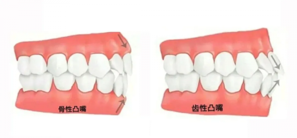 被凸嘴困擾的中國女孩，都是隱藏的大美人