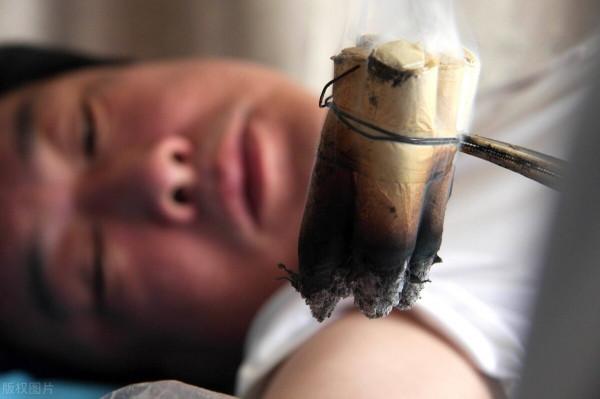 艾灸治療風溼類風溼有效果嗎？需要長時間才能夠改善症狀