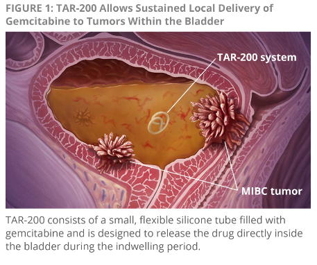 新型膀胱內給藥系統TAR-200治療MIBC，病理緩解率達到60%