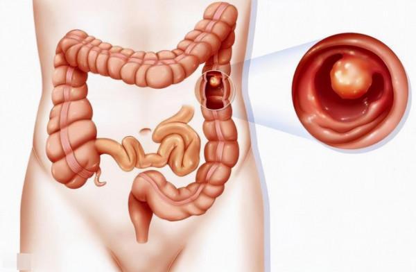 身體5個地方長“黑痣”，或許是腸息肉的“暗示”，要引起警惕