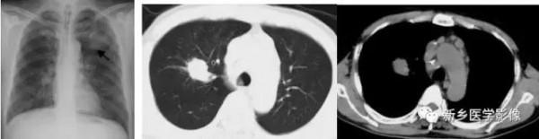 肺部5大基本病變,影像診斷的基礎 肺部5大基本病變,影像診斷的基礎