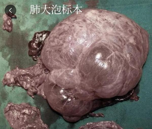 肺大泡相關（診治）問題