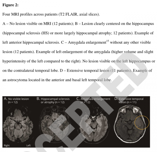 Neurology：已證實！顳葉癲癇患者主觀記憶抱怨背後，客觀記憶缺陷確存在