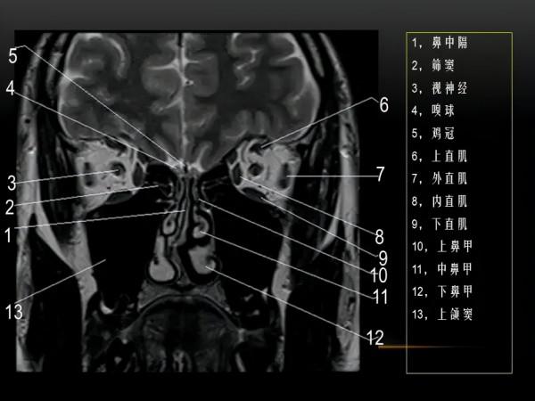 MRI下眼部及鼻竇解剖