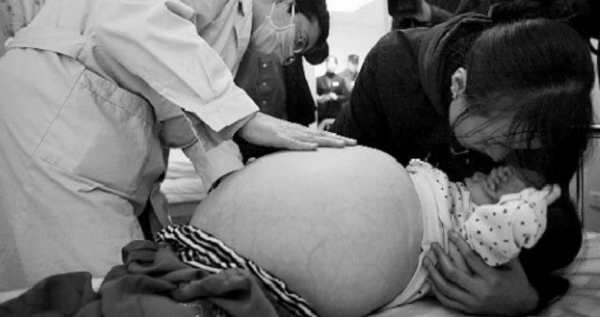 還記得那個得“怪病”肚子大過孕婦的山西女童嗎？後來治好了嗎？