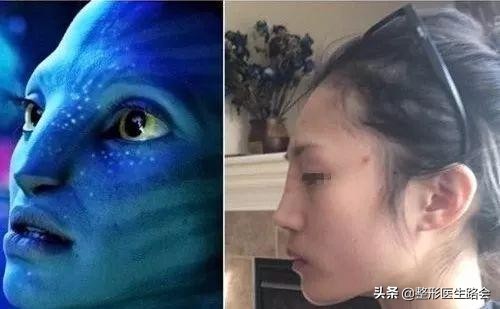 整形醫生“路會”告訴你，這5個部位最好別打玻尿酸