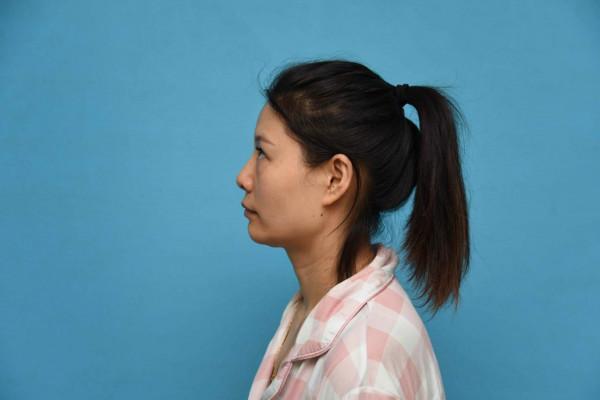 33歲老阿姨做完自體脂肪面部填充60天,閨蜜說我年輕了不止10歲 33歲老阿姨做完自體脂肪面部填充60天,閨蜜說我年輕了不止10歲