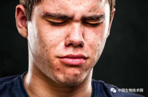 臉上、牙齒上積累的細菌會不會導致痤瘡和牙齦炎？拍張照片看看&period;&period;&period;