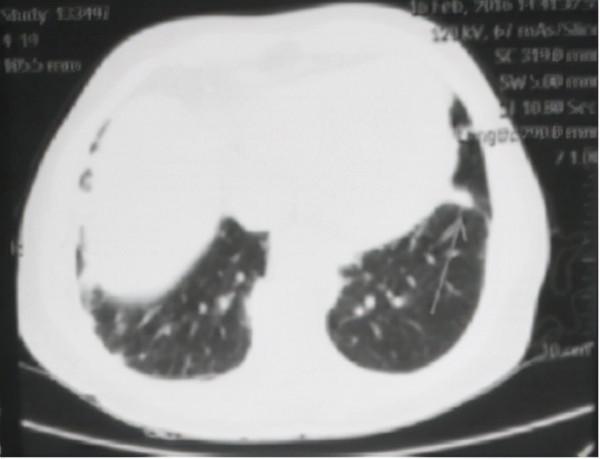 經常咳嗽誤以為是感冒,卻是肺結節,中藥調理祛風化痰、清肺止咳 經常咳嗽誤以為是感冒,卻是肺結節,中藥調理祛風化痰、清肺止咳