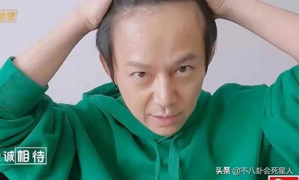 明星&OpenCurlyDoubleQuote;禿頂&rdquo;群像，中年男星頭頂稀疏成重災區，女星靠假髮片社交