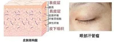 眼周的小坨坨，不痛不癢，是什麼呀？