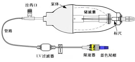 行動式化療泵化療,你知道多少? 行動式化療泵化療,你知道多少?