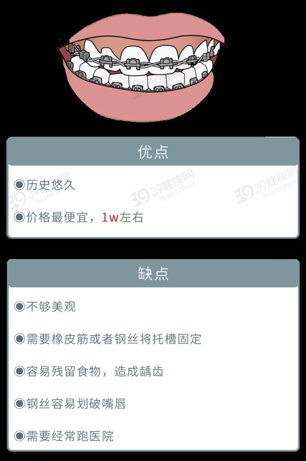 為什麼只要戴牙套,牙齒就可以恢復得很整齊?生動展示矯正過程 為什麼只要戴牙套,牙齒就可以恢復得很整齊?生動展示矯正過程