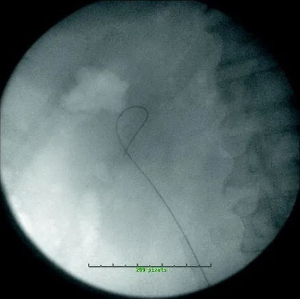 輸尿管軟鏡終於有了用武之地!​這主要是因為有了通路鞘 (UAS) 輸尿管軟鏡終於有了用武之地!​這主要是因為有了通路鞘 (UAS)