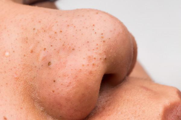 如何去黑頭快速又有效？4個好用的去黑頭的方法，便宜又有效