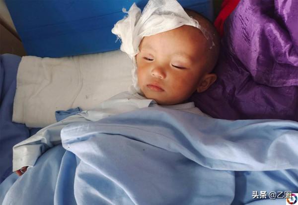 男孩發生意外失去半個腦殼，父親自責，只想給孩子一個正常的腦袋