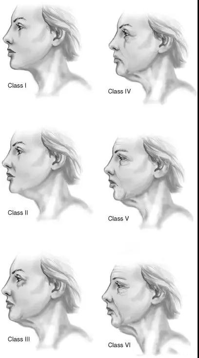 頸部吸脂：頸部下垂分級，看看你屬於幾級？