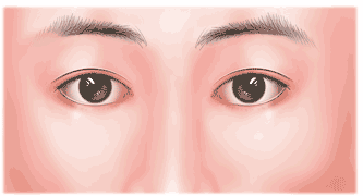 你知道眼袋形成的4種原因是什麼嗎？