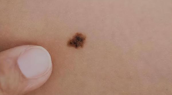 醫生提醒：若黑痣長在這4個部位，要密切關注，及早做檢查