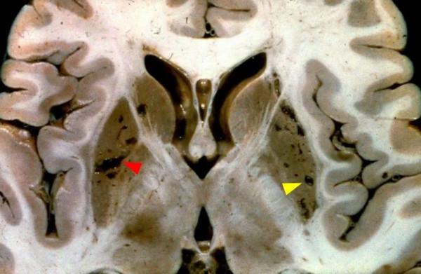 VR腔隙、腔梗灶、微出血、脫髓鞘，傻傻分不清？快看這裡