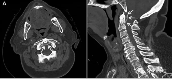 頸椎少見的3種鈣化性疾病 頸椎少見的3種鈣化性疾病