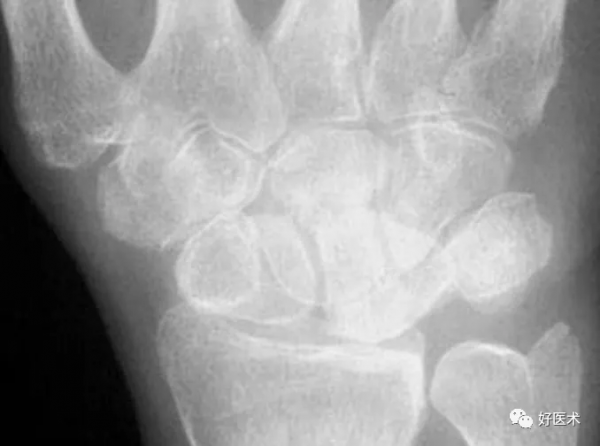 贊！腕關節X線高畫質解剖+腕骨脫位典型病例