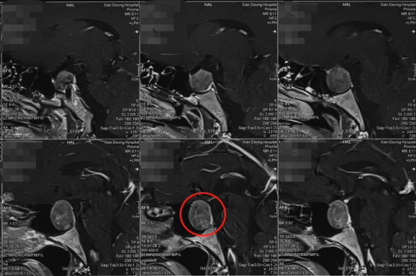 44歲加拿大華人萬里求醫，神外專家妙手除疾