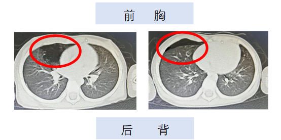 寶寶咳嗽後出現了呼吸困難 寶寶咳嗽後出現了呼吸困難