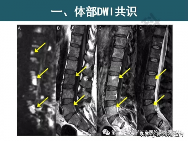 體部DWI共識及胰腺DWI研究經驗介紹