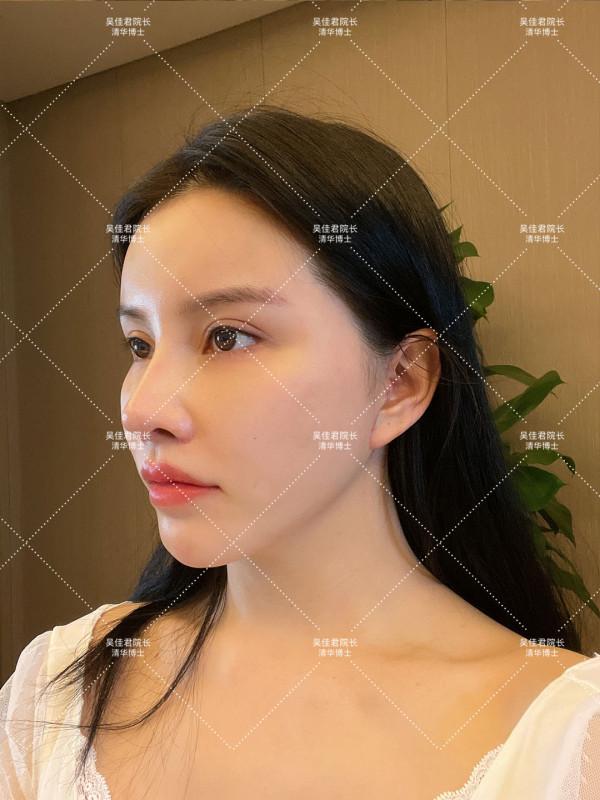 32歲姑娘小拉皮術後7個半月，變得年輕又精緻，前後反差很大