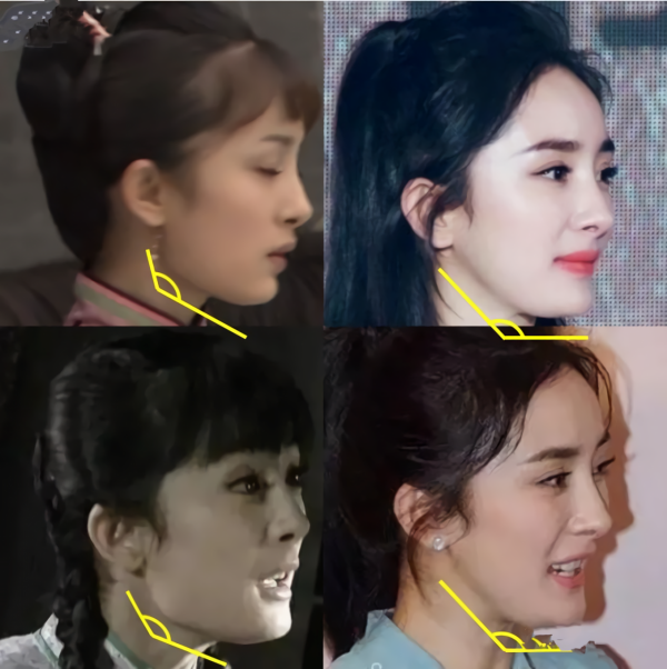 那些“一刀切”削臉的明星還好嗎？有的已垮掉，小方臉成最後贏家