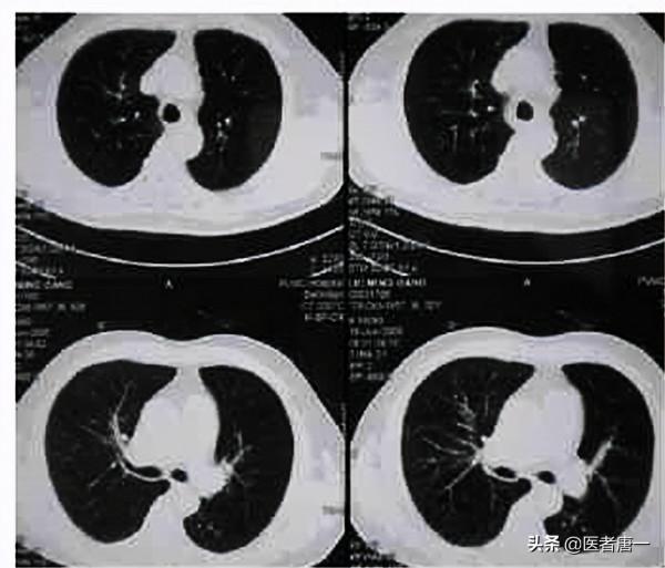 慢性肺病的朋友,建議你鍛鍊膈肌,膈肌是呼吸的發動機 慢性肺病的朋友,建議你鍛鍊膈肌,膈肌是呼吸的發動機
