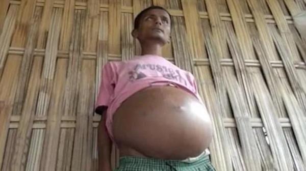 2012年男孩肚子越漲越大，每天只能睡1小時，後來怎麼樣了？