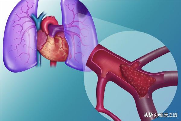 只是小腿腫脹,卻差點因肺栓塞喪命!靜脈血栓的危害可能超乎想象 只是小腿腫脹,卻差點因肺栓塞喪命!靜脈血栓的危害可能超乎想象