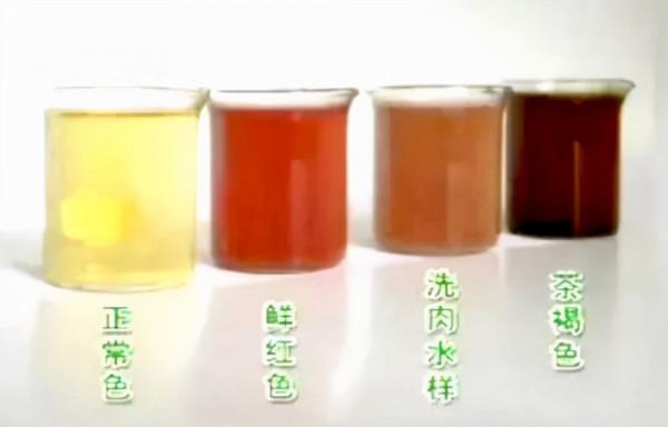 小夥150個深蹲後，排出“醬油尿”，醫生：一週接診三個年輕人了