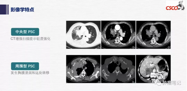 肺肉瘤樣癌治療進展