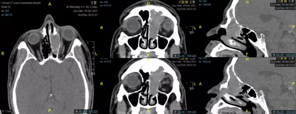 南昌大學二附院耳鼻咽喉頭頸外科成功診治鼻腔鼻竇轉移性腎透明細胞癌患者
