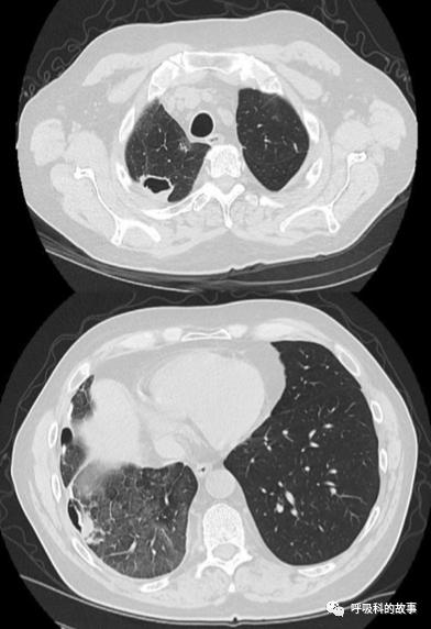 62歲男性患者呼吸急促、乾咳3個月，卻被誤診3個月，這樣的事件你能接受嗎？