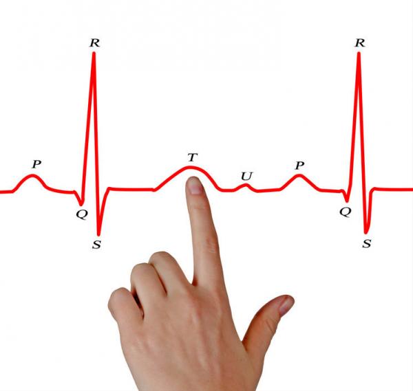 心電圖T波改變是怎麼回事兒?就是冠心病嗎? 心電圖T波改變是怎麼回事兒?就是冠心病嗎?