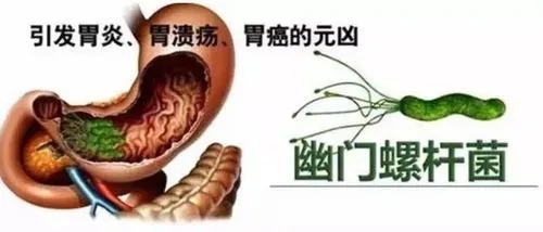 解讀胃部“幽門螺桿菌”感染，本是同根生，相煎何太急