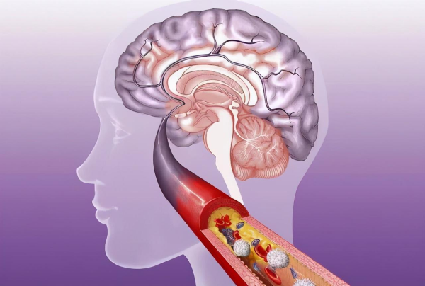 家人突發腦出血咋辦？醫生教你家庭急救辦法，家人有高血壓的請看