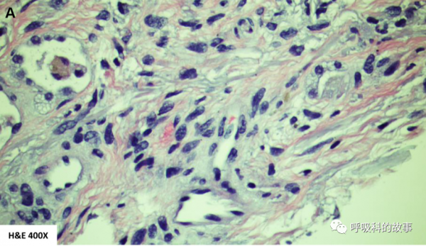 62歲男性患者呼吸急促、乾咳3個月，卻被誤診3個月，這樣的事件你能接受嗎？