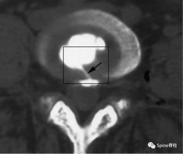 椎間盤源性腰痛 (discogenic low back pain) 椎間盤源性腰痛 (discogenic low back pain)