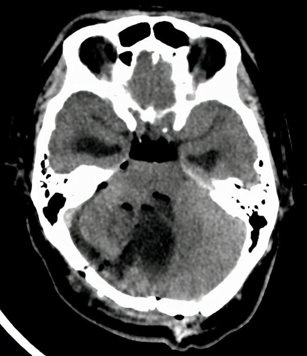 中年男子走路像醉漢，檢查發現腦內生出“戒指”