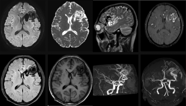 腦動靜脈畸形影像學特徵