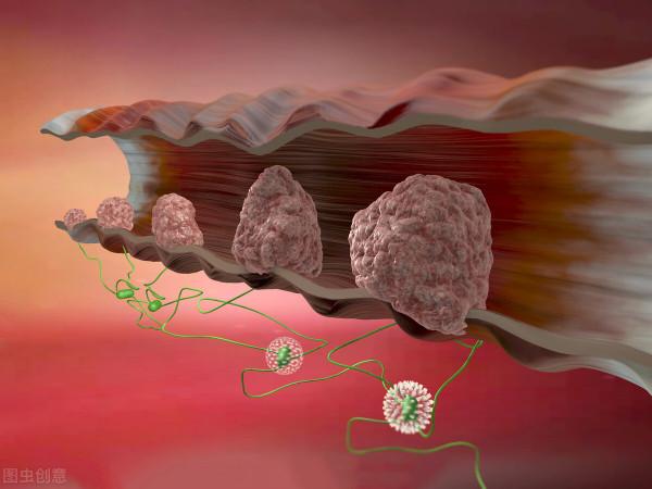 直腸癌多半是“拖”出來的！醫生提醒：身體有2個感受，抓緊檢查