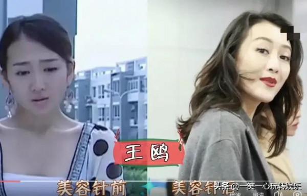 被“美容針”摧殘的女星，戚薇笑都不自然，舒暢真成“天山童姥”